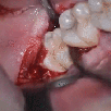 dentiste-molaire-dent-risitas-de-sagesse-extraction-gif