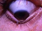 lunette-oeil-cancer-keratocone-lentilles-yeux-ophtalmologue-maladie