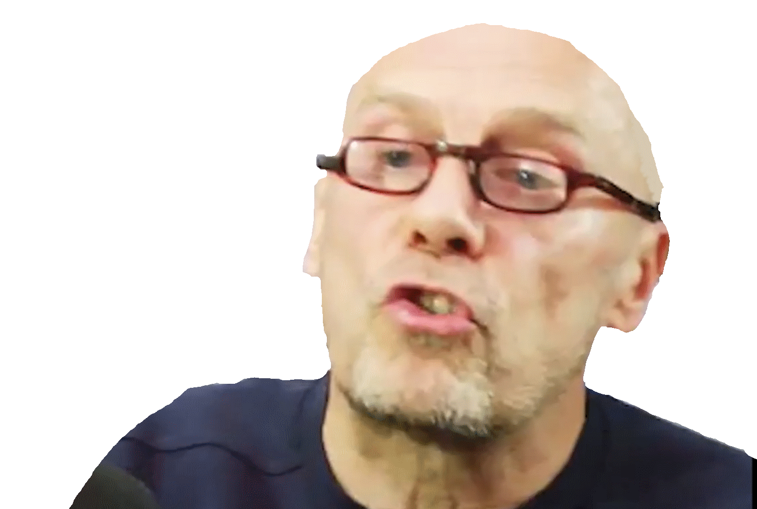 consanguin trisomique triso politic mongol microcephale soral