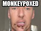 variole-singe-monkeypox-virus-orthopox-bubon-pustule-pustuleux-pride