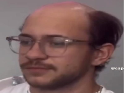 calvitie calvos chauve