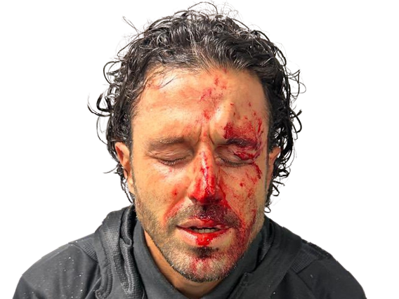 grosso fabio ensanglante italien lyonnais football lyon sang agression agresse battu frappe ultra hooligan hooliganisme