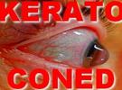 keratocone-ophtalmologiste-yeux-oeil-oculaire-pointe-retine-macula-pupille-maladie-frottement-selection-naturelle