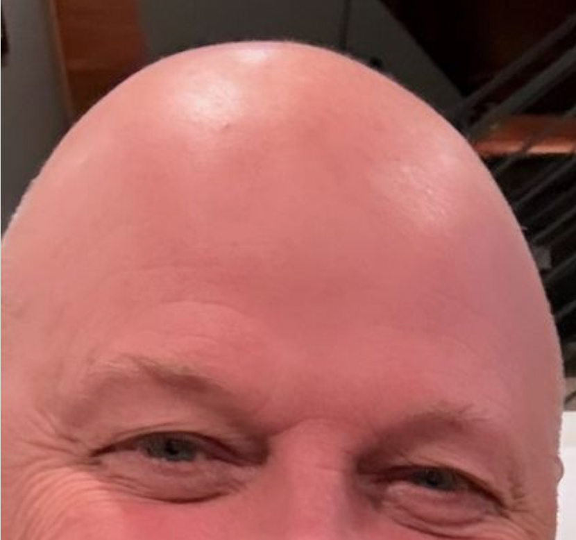 vu crane chauve calvitie