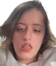 louise triso handicape regard yeux strabisme moche gogol zinzin femme