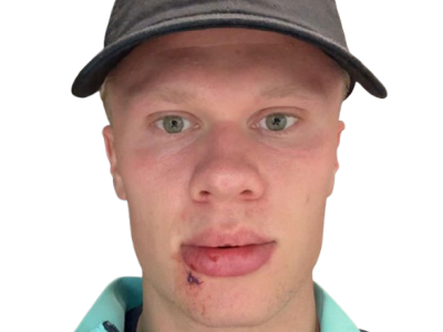 erling haaland hypnose casquette blessure flippant terreur selfie grosse tete bobo blesse regard croute