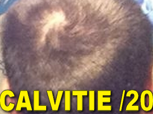 calvitie sur 20 immondice chauve aya