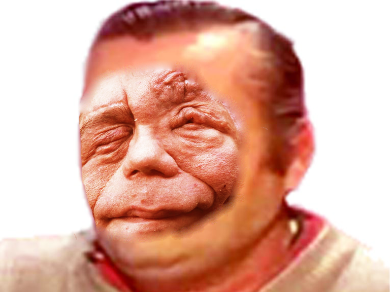 gange malformation risitas